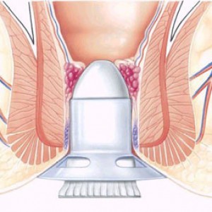 anoscopia