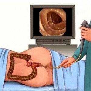 colonscopia