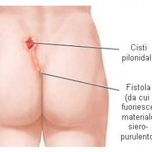 Fistola Anale