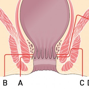 fistola